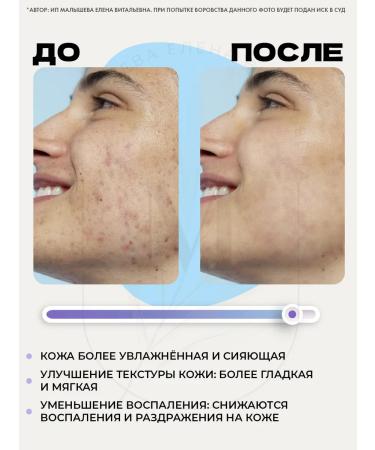 mixsoon Acne cream Bifida Cream 60 ml - Buy Online on GoSupps.com