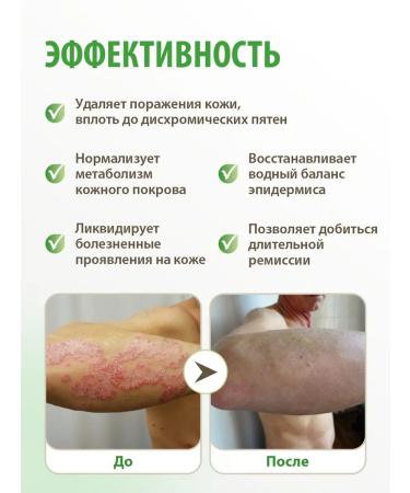 Acrustal Psoriasis ointment healing cream - Buy Online on GoSupps.com