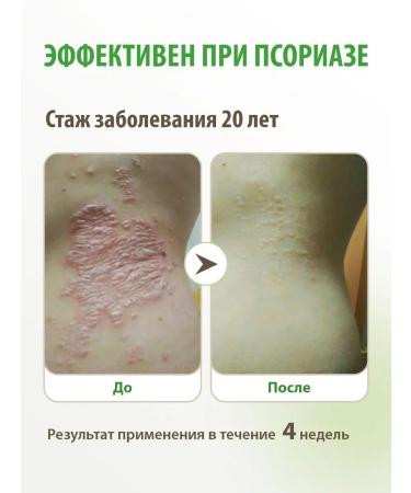 Acrustal Cream from dermatitis and psoriasis - Buy Online on GoSupps.com