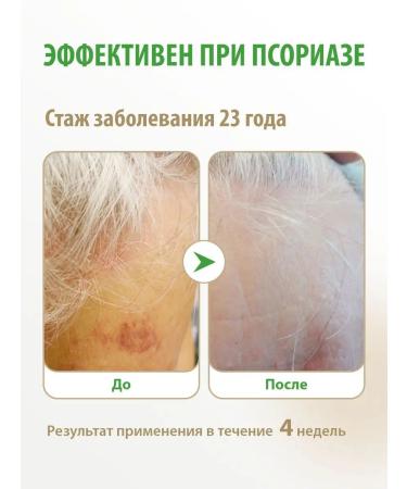 Acrustal Ointment from psoriasis on the head - Buy Online on GoSupps.com
