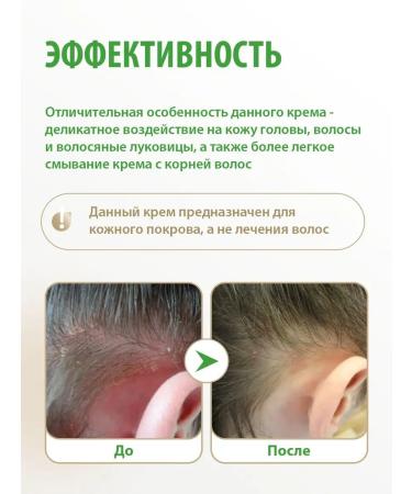Acrustal Cream for problem scalp and dermatitis - Buy Online on GoSupps.com