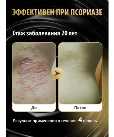 Acrustal Ointment from psoriasis with Naftalan - Buy Online on GoSupps.com