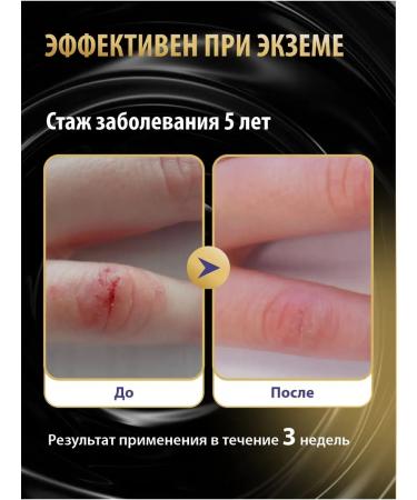 Acrustal Ointment from psoriasis with Naftalan - Buy Online on GoSupps.com