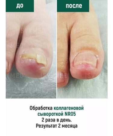 ISVYMED Collagen serum for nails - Buy Online on GoSupps.com