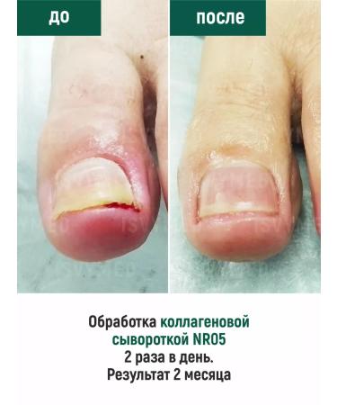 ISVYMED Collagen serum for nails - Buy Online on GoSupps.com