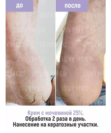 ISVYMED Stop cream with 25% urea - Buy Online on GoSupps.com