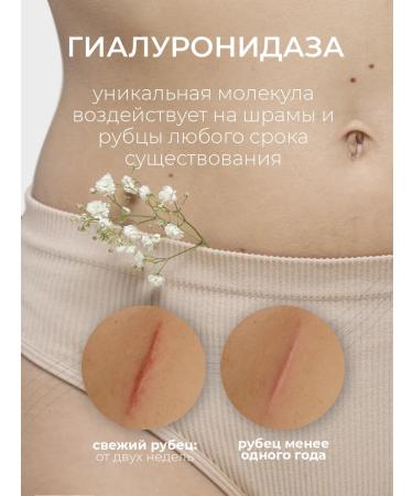 Imopherase Cream from stretch marks scars and post -acne - Buy Online on GoSupps.com