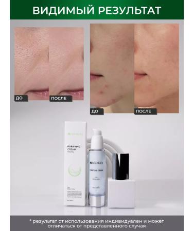 Matrigen Acne cream 50ml - Buy Online on GoSupps.com