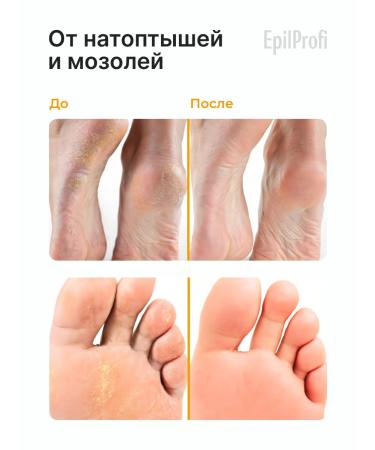 EpilProfi Cream wax from cracks and peeling for hands and body set 2 pcs - Buy Online on GoSupps.com