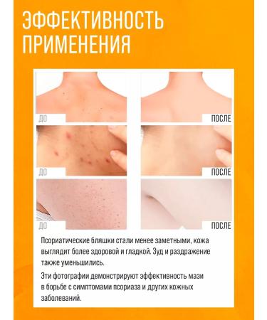 ZUDAIFU 2 pcs cream ointment from psoriasis for the face and body Zudaifa - Buy Online on GoSupps.com