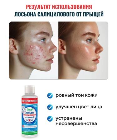 PROPELLER Salicylic lotion from acne for a comb. skin 100 ml - Buy Online on GoSupps.com