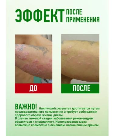 Acrustal Ointment from psoriasis eczema and dermatitis "Classic" 165 ml - Buy Online on GoSupps.com
