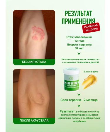 Acrustal Ointment from psoriasis is effective - Buy Online on GoSupps.com