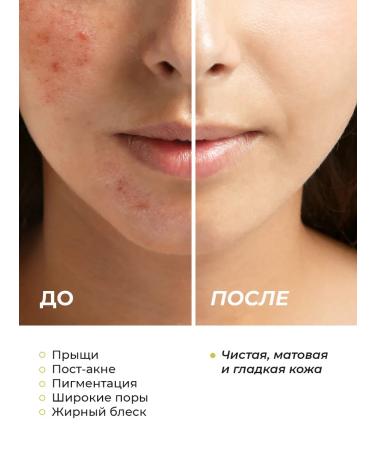 Seauty Cream for problem skin against acne moisturizing - Buy Online on GoSupps.com