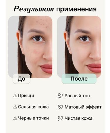 Apoterm Facial serum from acne and acne for narrowing pores - Buy Online on GoSupps.com