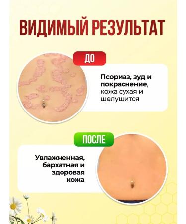 The Magic Bee Cream from psoriasis - Buy Online on GoSupps.com