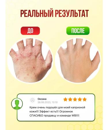 The Magic Bee Cream from psoriasis - Buy Online on GoSupps.com