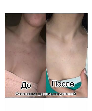 Butterfly Acne and acne lotion on the face and body 250 ml - Buy Online on GoSupps.com