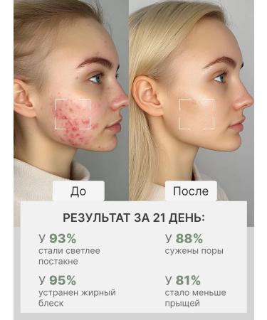 Butterfly Acne and acne lotion on the face and body 250 ml - Buy Online on GoSupps.com