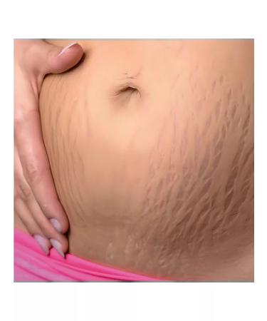 BREYLEE From stretch marks and scars for the body after childbirth