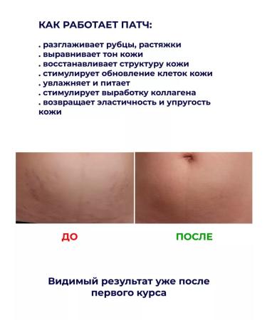 BREYLEE From stretch marks and scars for the body after childbirth - Buy Online on GoSupps.com
