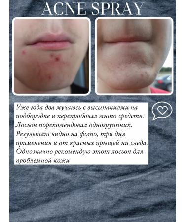 cosmetologist Acne remedy - Buy Online on GoSupps.com