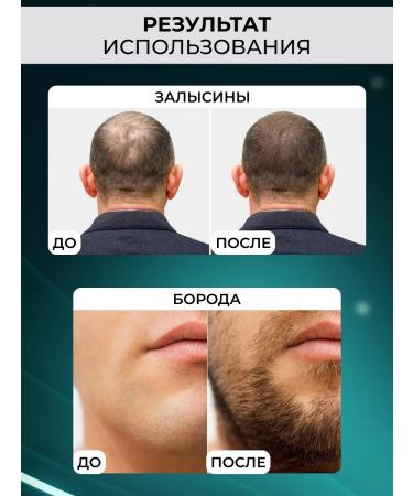 DRS Mesoroller for hair beards and faces 1mm - Buy Online on GoSupps.com