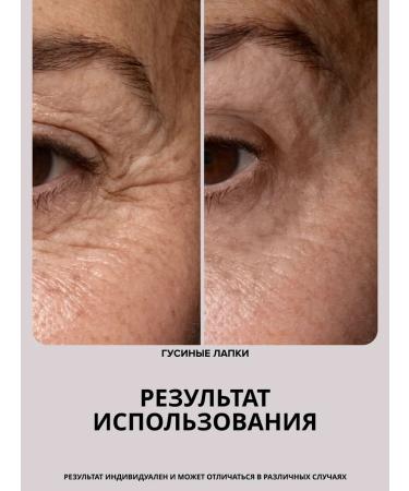 DRS Mesoroller for face against wrinkles and pigmentation 0.3mm - Buy Online on GoSupps.com