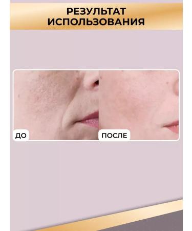 ZGTS Mesoroller for Voloc and a beard growth 1 mm - Buy Online on GoSupps.com