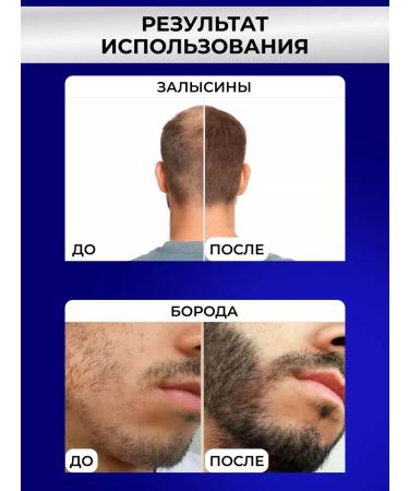 ZGTS Mesoroller for the face and growth of hair and beard 1mm - Buy Online on GoSupps.com