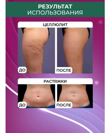 DRS Mesoroller for body against cellulite and stretch marks 2 mm - Buy Online on GoSupps.com