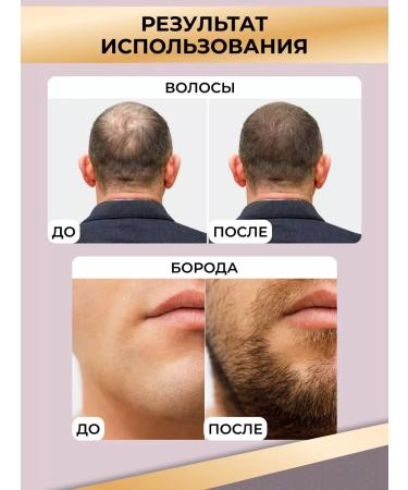 ZGTS Mesoroller for the face and growth of hair and beard 1.5 mm - Buy Online on GoSupps.com