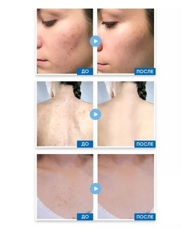 EWAM Face acne cream with salicylic acid 0.5% - Buy Online on GoSupps.com