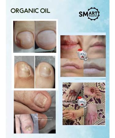 SMART Nail oil with a monard from onycholysis and fungus - Buy Online on GoSupps.com