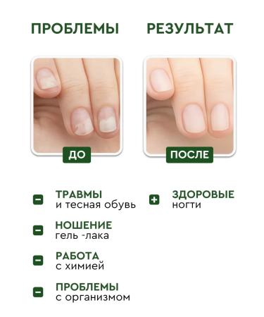 INKI Currents against the onycholysis and fungus of serum and lotion 1i 2 - Buy Online on GoSupps.com