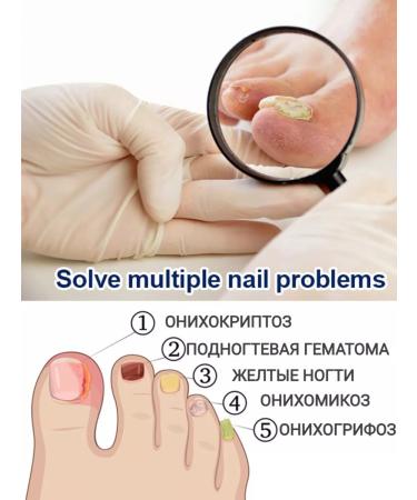 100% Original Anti-nail fungus cream - Buy Online on GoSupps.com