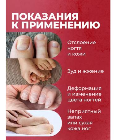 Althea Cream from nail and arms nail fungus - Buy Online on GoSupps.com