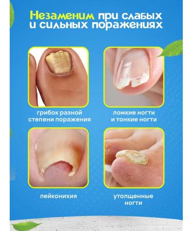 100% Original Chinese remedy for nail fungus - Buy Online on GoSupps.com