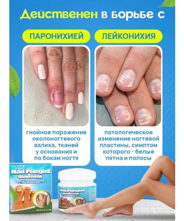 100% Original Chinese remedy for nail fungus - Buy Online on GoSupps.com