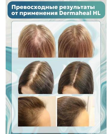 Dermaheal Her dermahil serum from hair loss 2 bottles - Buy Online on GoSupps.com