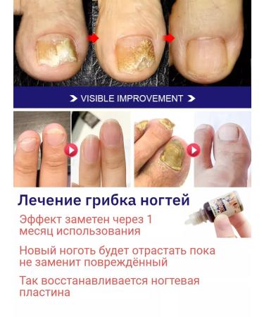 100% Original nail fungus remedy - Buy Online on GoSupps.com