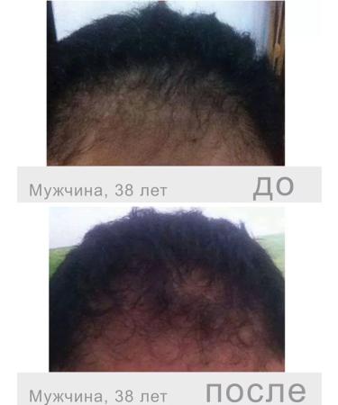 Fusion Mesotherapy Hair growth f-hair men - Buy Online on GoSupps.com