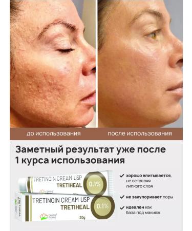 Secrets of India Tretinoin cream problem skin USP 0.1% - Buy Online on GoSupps.com