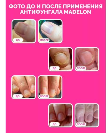 Madelon Remedy for nail fungus anti -pungal 4 ml - Buy Online on GoSupps.com