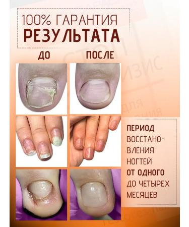 Giorgio Capachini Oil for restoration of footsteps onholysis 30 ml - Buy Online on GoSupps.com