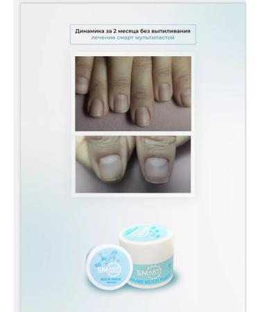 Smart Master Multipasta Smart Steak 10 ml from onycholysis nail fungus - Buy Online on GoSupps.com