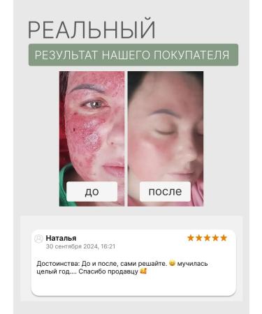 Butterfly Acne and acne lotion on the face and body 100 ml - Buy Online on GoSupps.com