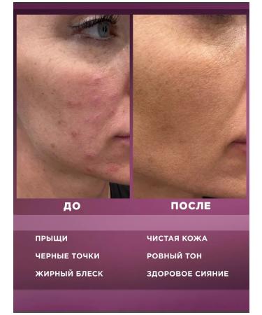 OzoneBox Super duet cosmetics set for problem skin - Buy Online on GoSupps.com