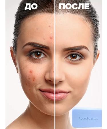 Cuticura Soap - pimples and acne foam for problem skin 2x85g - Buy Online on GoSupps.com