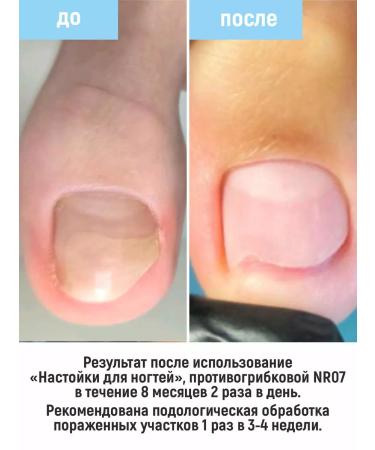ISVYMED Antifungal tincture for nails - Buy Online on GoSupps.com